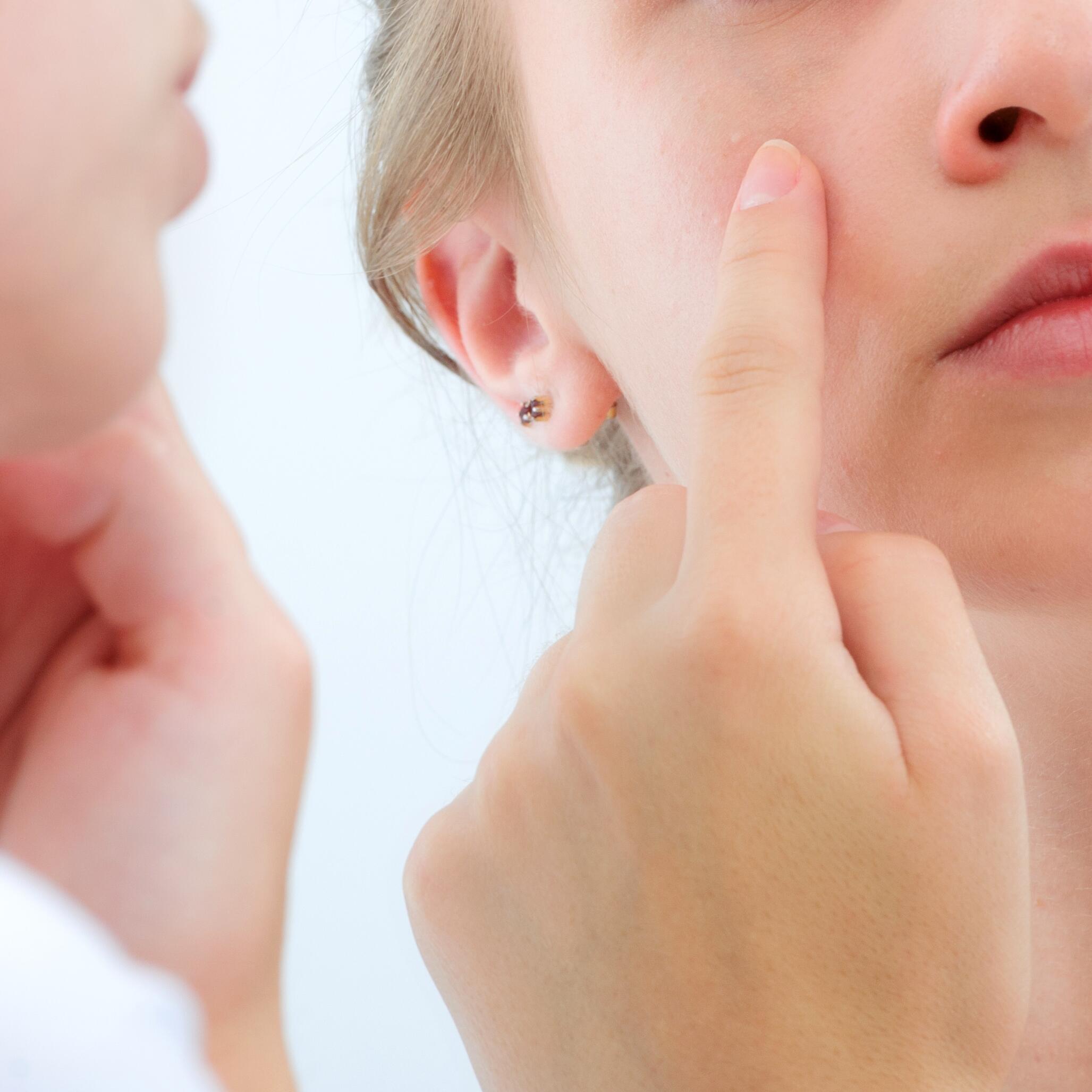 L’acné hormonale chez l’adolescent